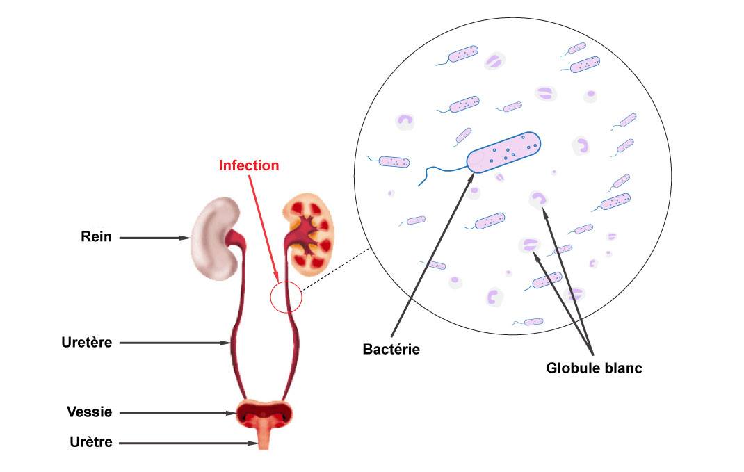 schema-infection-urinaire