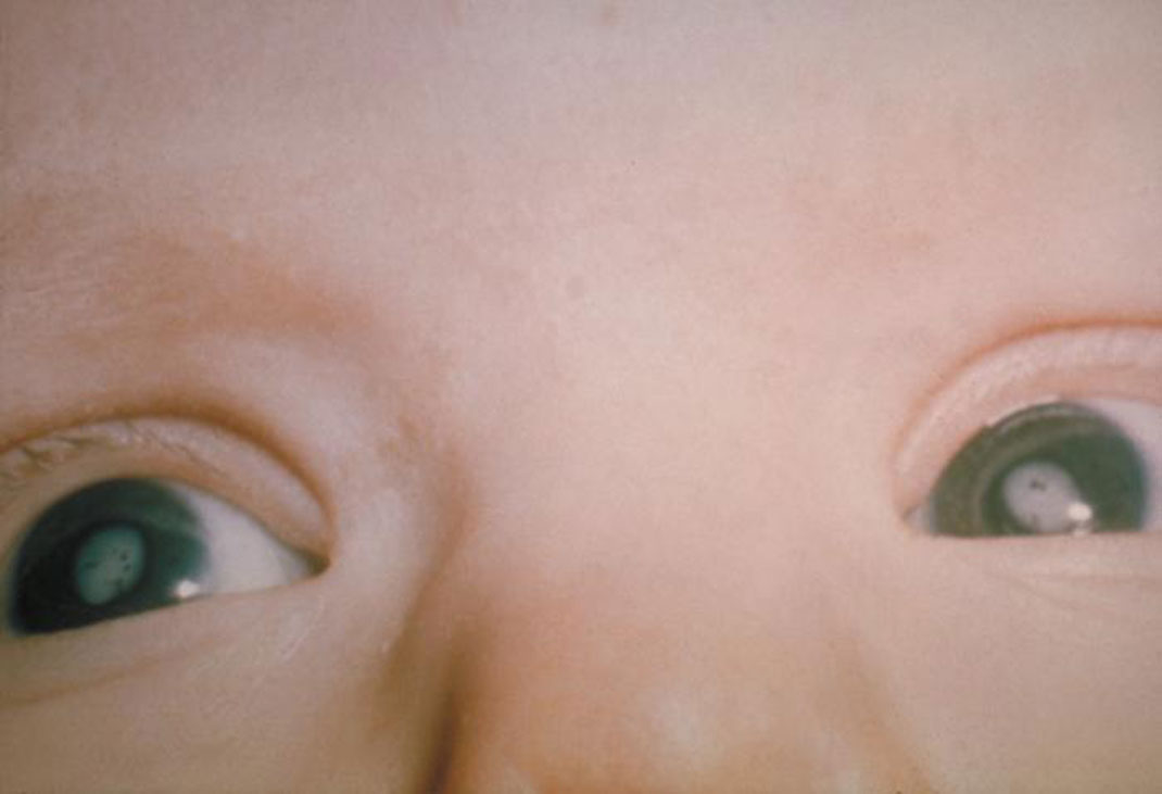 cataracte-enfant