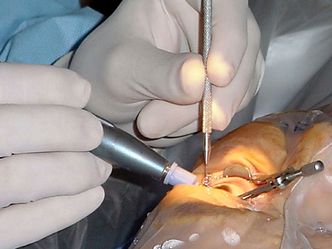 cataracte-operation