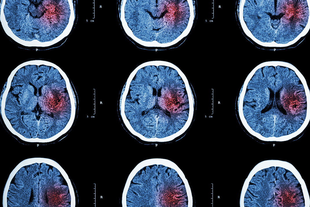 Cerveau d'un patient via Shutterstock