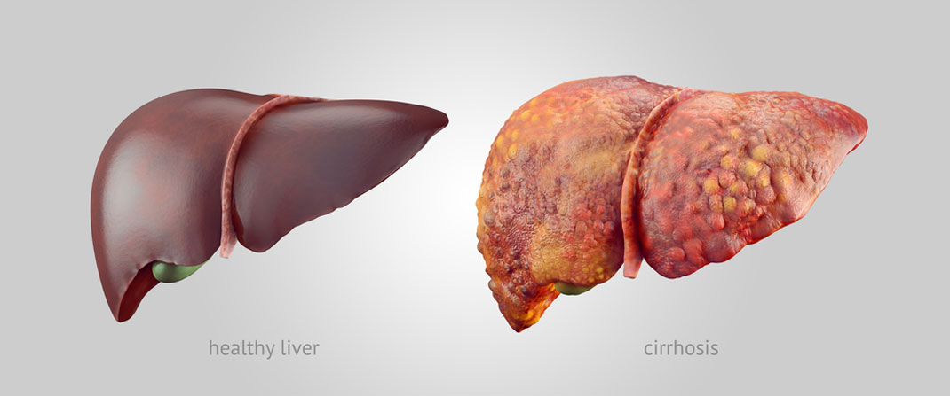 La comparaison d'un foie sain à un foie avec une cirrhose via Shutterstock