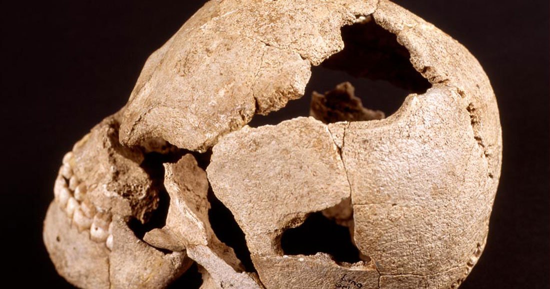 Pourquoi nos ancêtres se faisaient-ils des trous dans le crâne ?