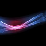 Fracture osseuse