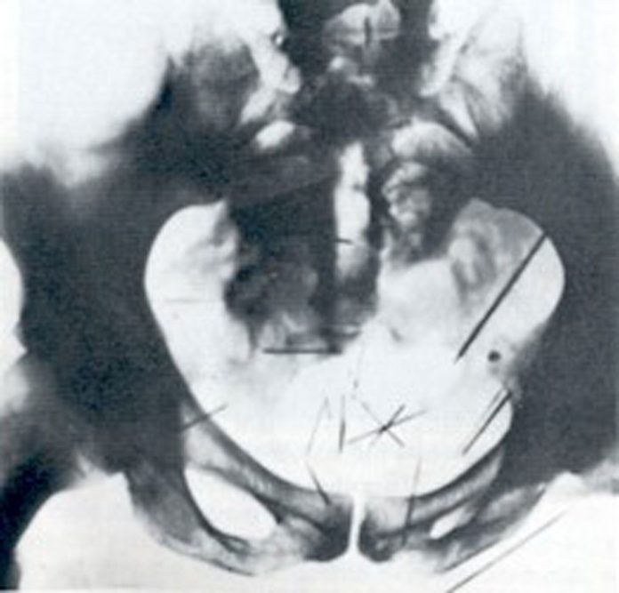 Qui tait Albert Fish Le Vampire De Brooklyn