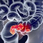 cancer colorectal