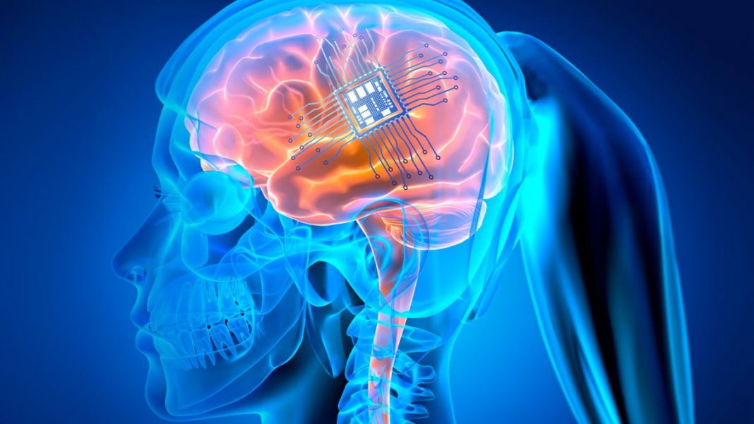 La dépression traitée pour la première fois à l’aide d’un implant