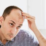 cheveux-homme-calvitie