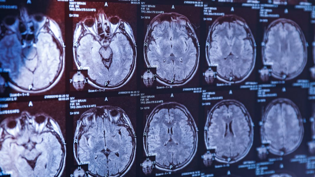 La maladie d'Alzheimer pourrait finalement ne pas être une maladie du ...
