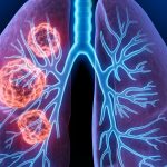 cancer-poumon