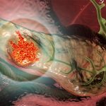 tumeur-cancer-pancreas