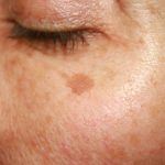 hyperpigmentation