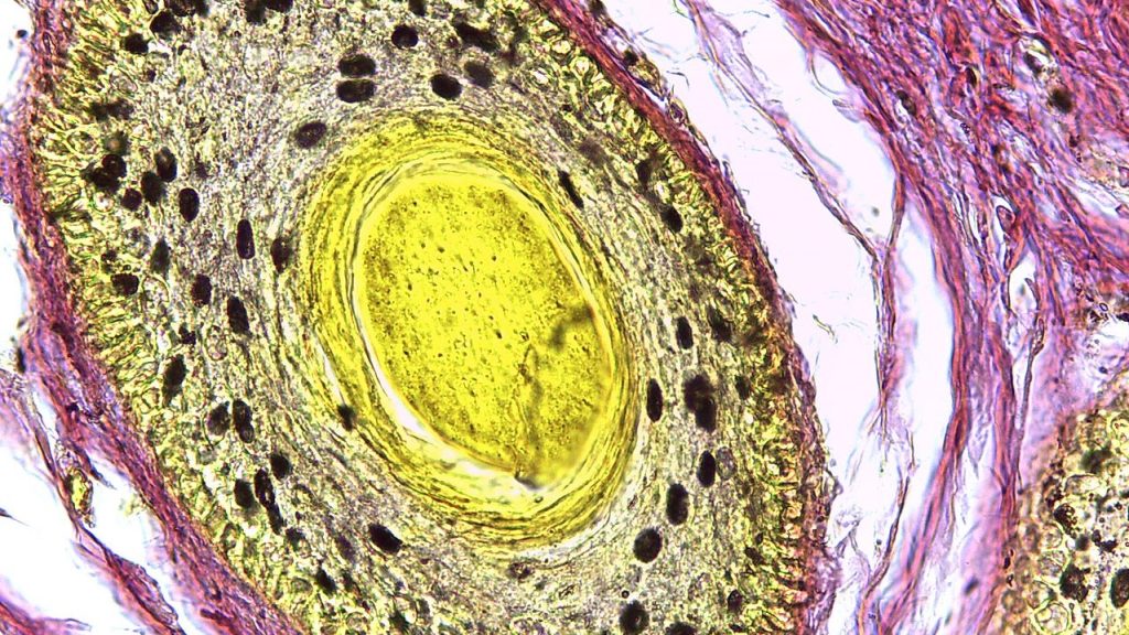 Quel est le plus ancien cas connu de cancer chez l'Homme