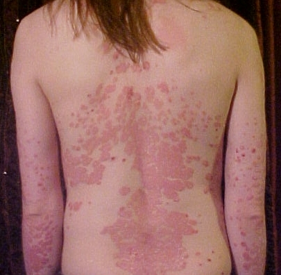 Psoriasis