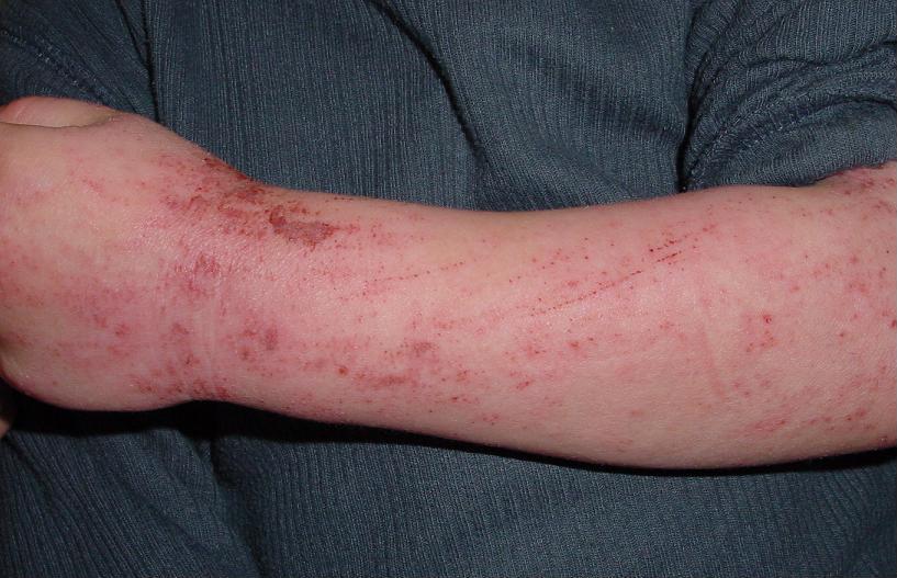 eczema