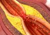 microplastiques-arteres
