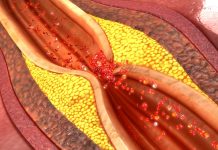 microplastiques-arteres