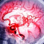 Anevrismes Cerebraux