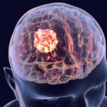 Cancer Cerveau