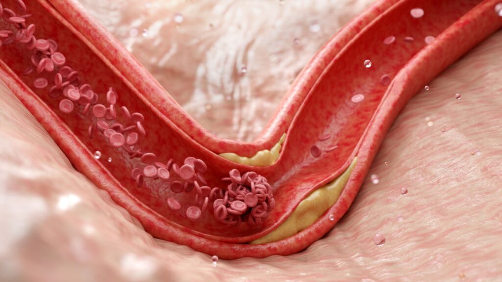 Plaques Arterielles