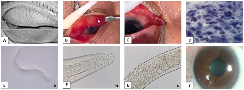 Parasite Oeil