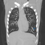 Implant Contraceptif