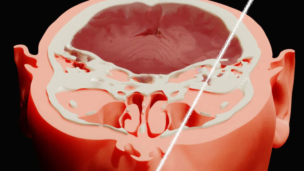 Crâne traversé par un faisceau de protons