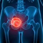 Illustration médicale montrant la prostate en surbrillance rouge dans le bassin masculin, représentant le cancer de la prostate.