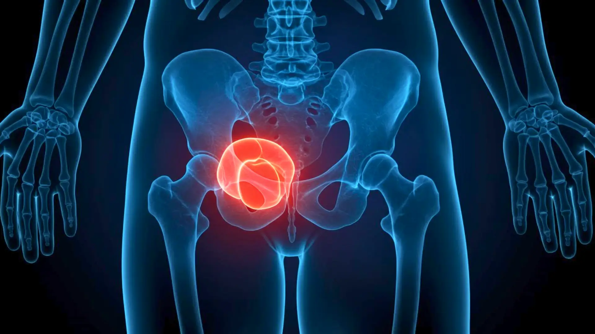 Illustration médicale montrant la prostate en surbrillance rouge dans le bassin masculin, représentant le cancer de la prostate.